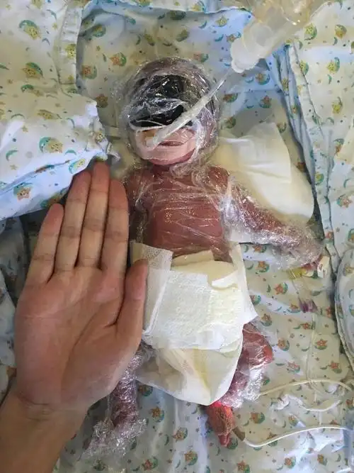 巴掌大小双胞胎早产三个月 裹保鲜膜保湿