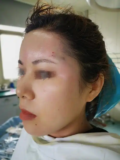 自体脂肪填充的颞部,额部 - 好大夫在线