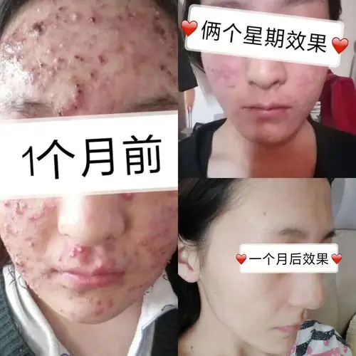 一个月祛痘秘籍