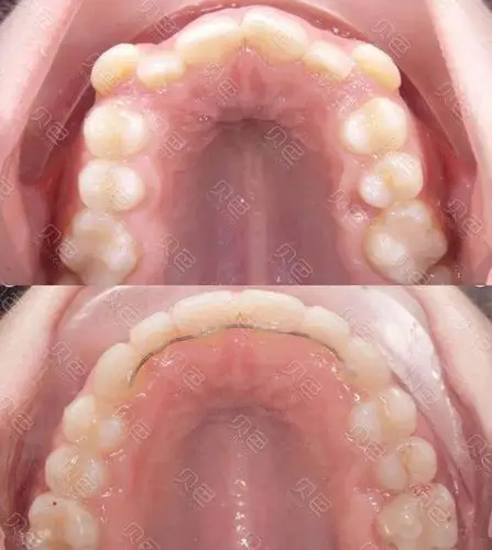 虎牙矫正前后对比效果