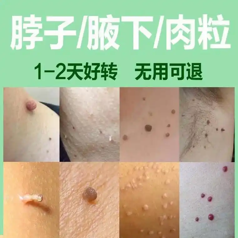 脖子上的小肉粒,我有办法对付你,用它#小肉粒 #皮肤健康#好 - 抖音
