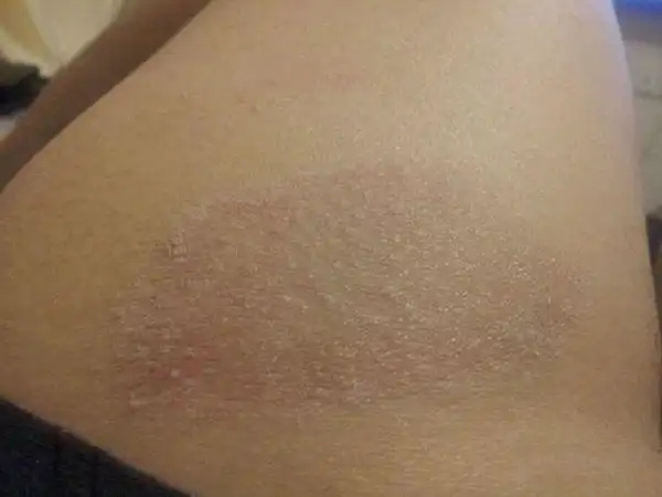 济南  病情描述(发病时间,主要症状等): 几个月前腿上起了这么一块癣