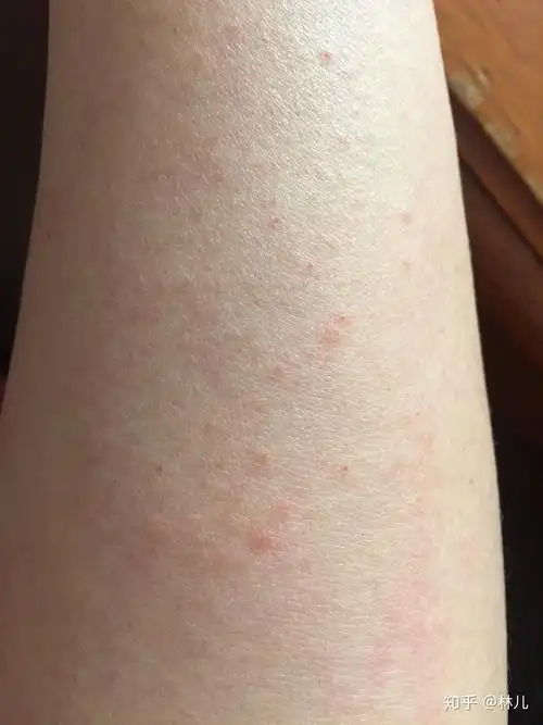 日光性皮炎的救星