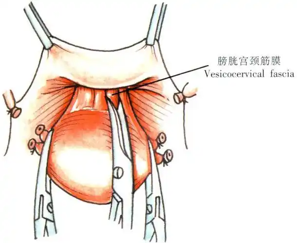 次全子宫切除术