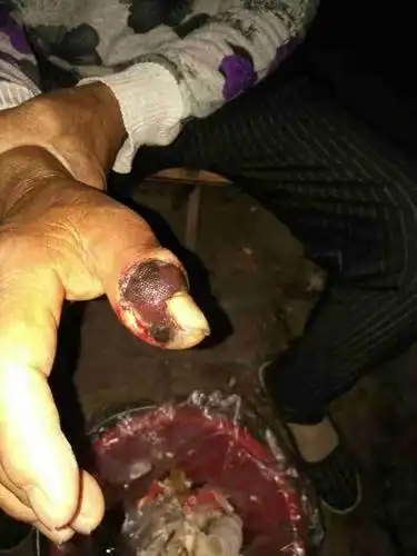 性别女,年龄68周岁,手指头溃烂严重是怎么回事?有图