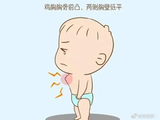 及时治疗阻止后悔!|鸡胸|胸骨|畸形_新浪新闻