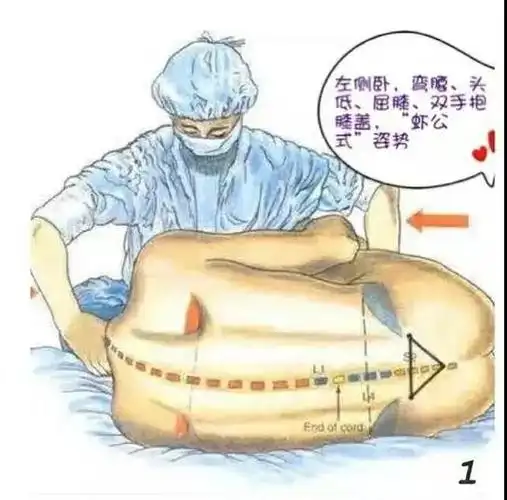 产妇疼痛剧烈时,麻醉医生在产妇的腰部进行穿刺,置入细小的硬膜外导管