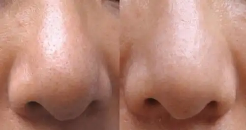 毛孔粗大|临沂瑞丽医学美容医院