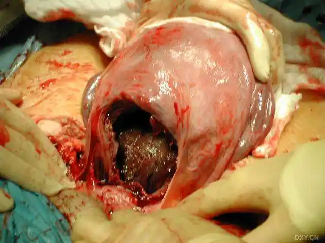 剖宫产真实图片 - 好大夫在线