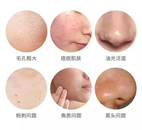 福利!换季肌肤问题5种症状以及应付措施送给爱护肤的伙伴