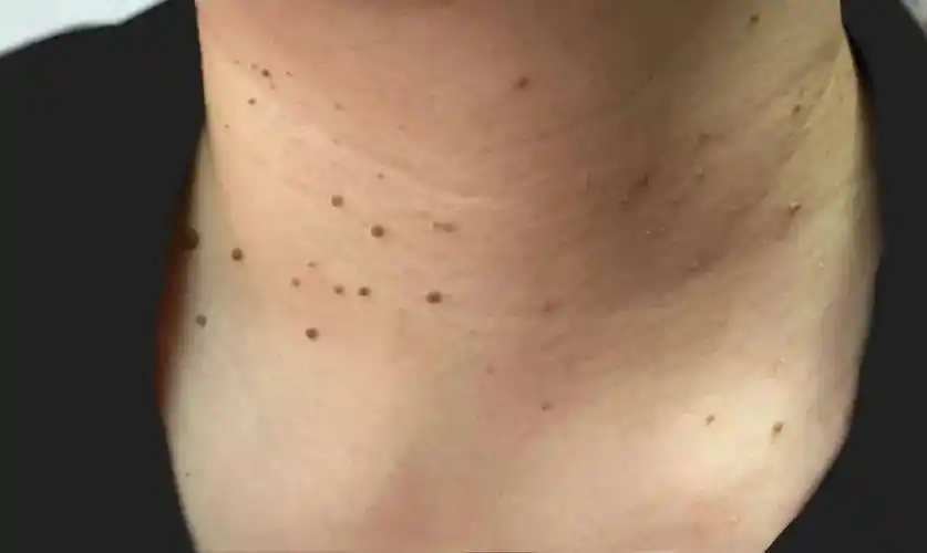 健康科普 | 皮肤突起的"小肉粒"——皮赘