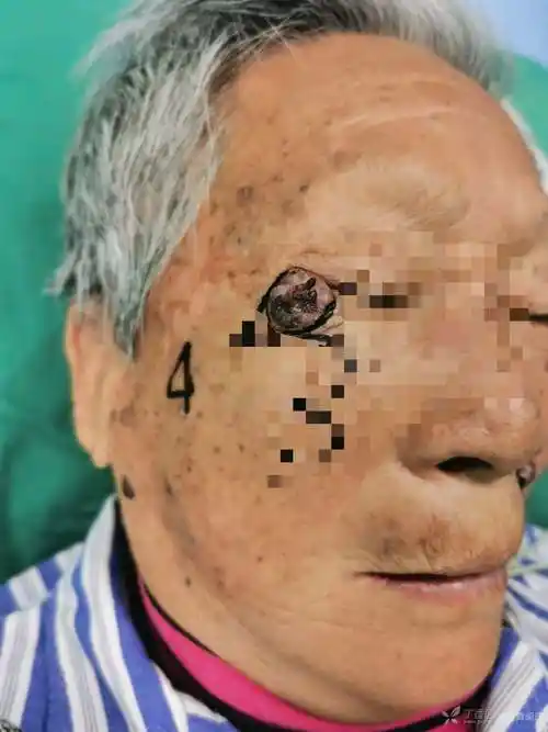 眼角肿瘤眼科不做给我推了过来