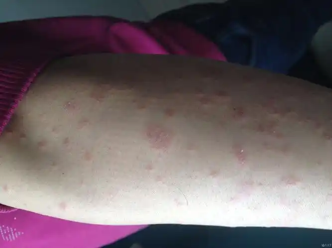 病例讨论这是牛皮癣吗