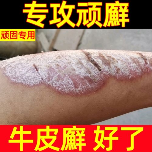手癣膏真菌感染苗家百草王治疗头皮癣的药膏螨虫过敏药牛皮癣药膏