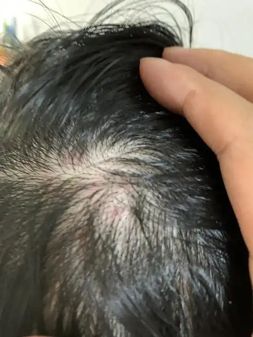 这样的头皮毛囊炎是不是已经很严重了图有点恶慎入