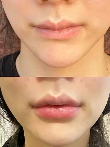 因为嘴巴比较干瘪,比较显老,所以想do嘟嘟唇很久了_圈子-新氧美容整形