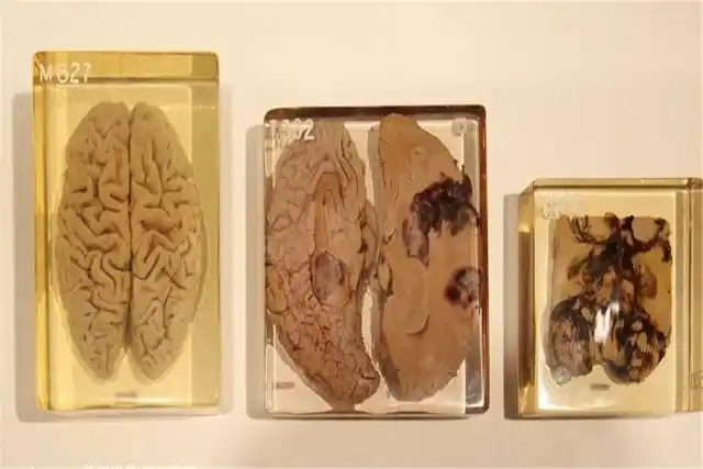 爱因斯坦逝世后,大脑被医生切成240片研究,为何要这么做?