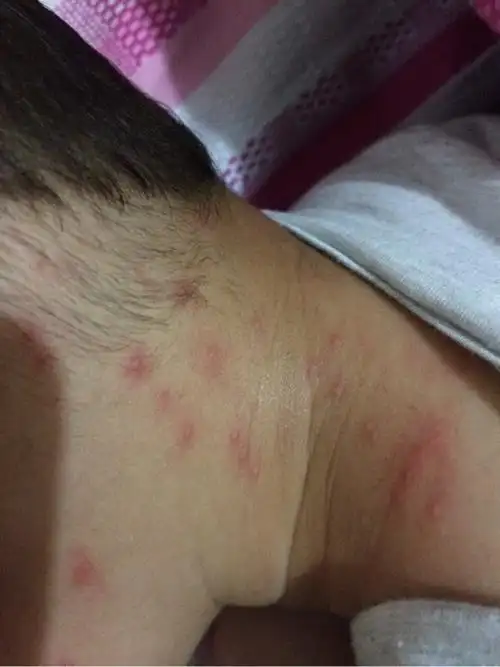 螨虫把宝宝弄得一身红疙瘩,如何有效防止宝宝被螨虫咬