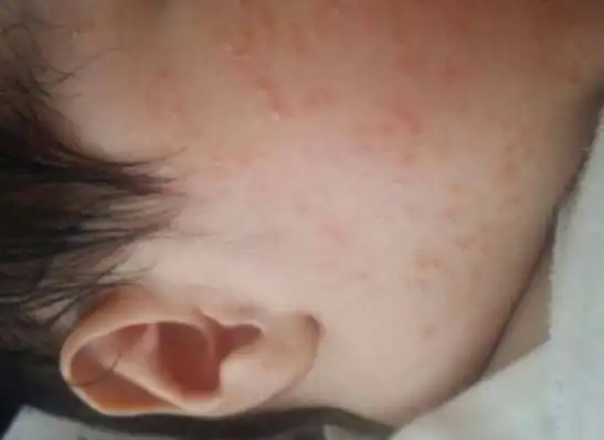 蛋白质过敏对宝宝影响大,家长们要细心观察!