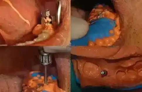 一期种植手术时,患者牙龈损伤严重,牙龈愈合成型不理想; 3.