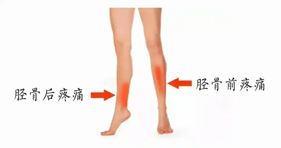 一跑步就小腿疼,怎么办?_胫骨_运动_应力