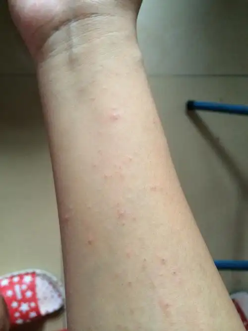 我吃了虾喂奶宝宝会不会是过敏?