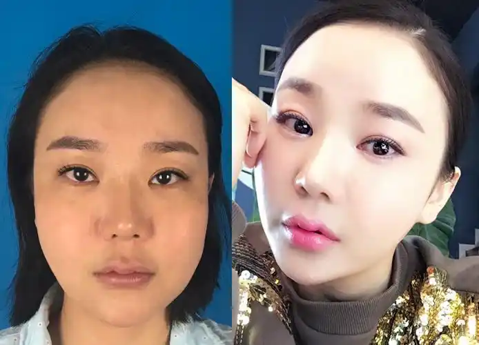 鲁树荣-面部脂肪填充后的八个注意事项