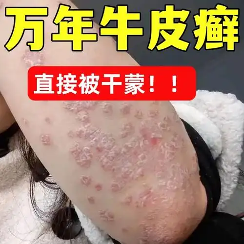 牛皮癣银屑癣藓皮肤瘙痒外用药手足藓体股藓真菌感染止痒特效药膏