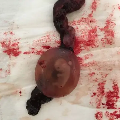 被医生告知为稽流流产,一直没有去清宫,两天后我的宝宝流出来了,伤心