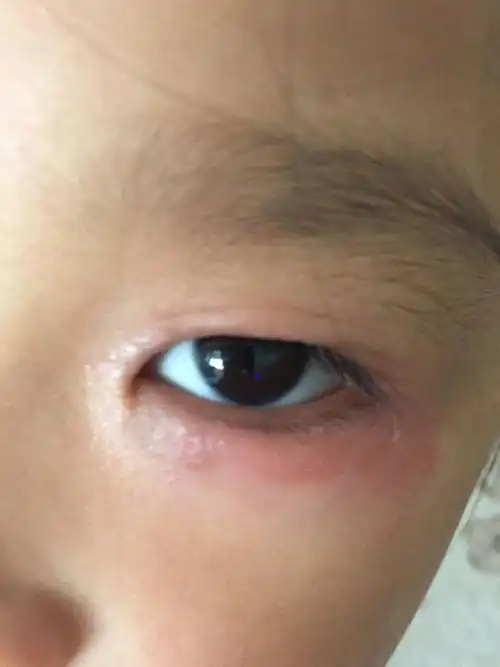 5岁小孩从1岁多开始就眼睛周围红红的脱皮不痒不痛