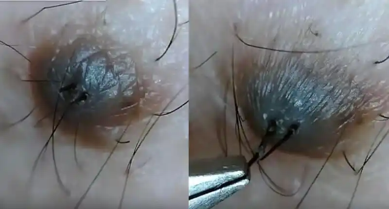 为什么痣上长毛?到底能不能拔?