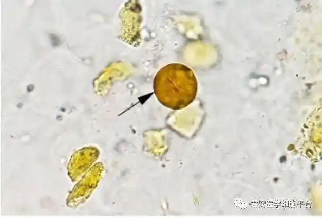 点击空白处查看答案亮氨酸结晶2021311请报告箭头所指有形成分的名称