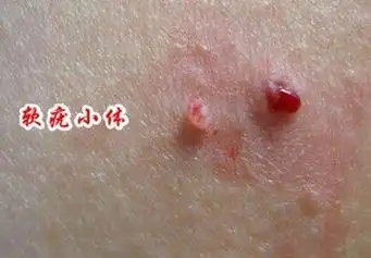 难言的外生殖器皮肤病之传染性软疣