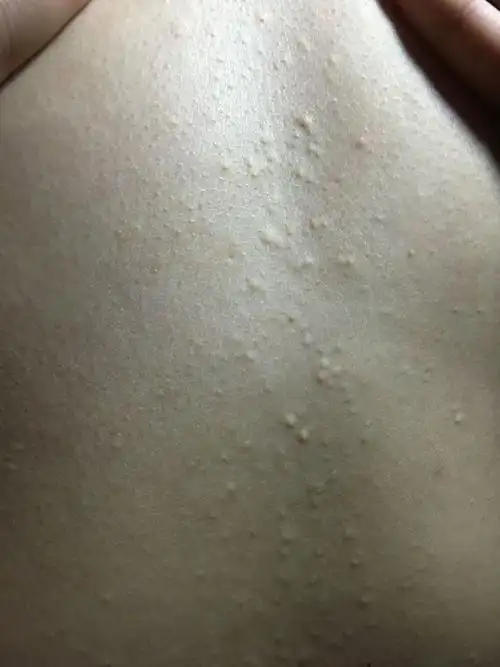 从胸前到肚脐眼一年多了不疼不痒 感觉像粉刺que请问这