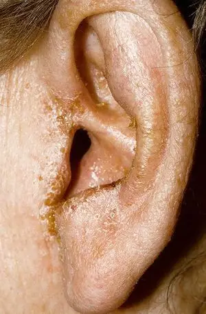 耳朵也会长湿疹?耳朵反复瘙痒怎么办?