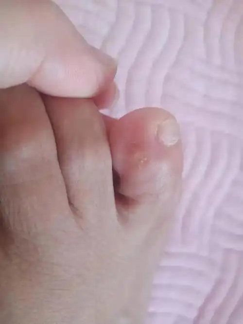 鸡眼完美修复日记以后就不要穿紧鞋子了