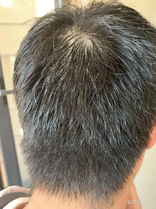 前几年头顶发现张了几根白头发,最近发现白头发特别多了,是什么原因