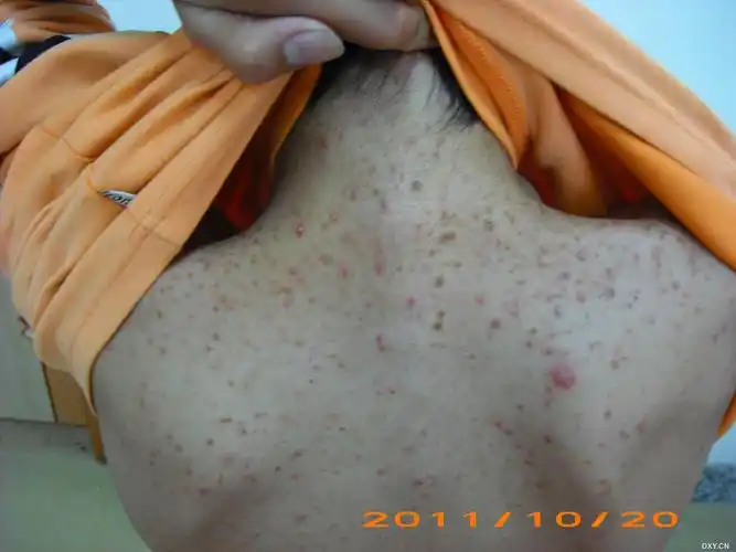 【共享】马拉色菌性毛囊炎