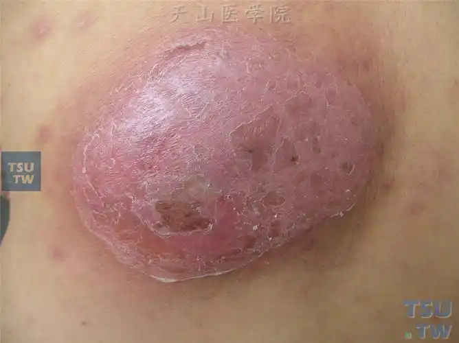 毛囊炎,疖和痈的症状表现