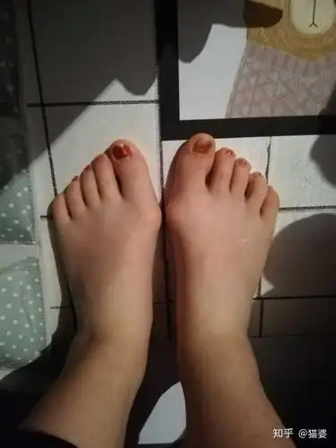 女生脚趾拇外翻是什么样体验?
