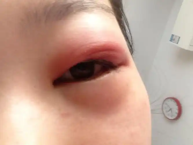 长了麦粒肿,这两天有吃药也有热敷,结果