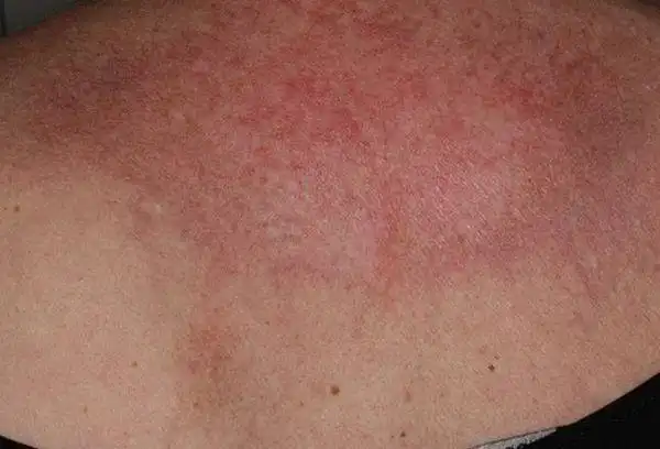 1,糖尿病皮肤病变