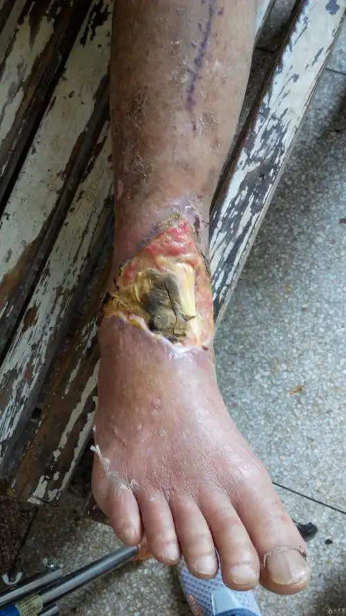 这个皮肤坏死缺损如何修复