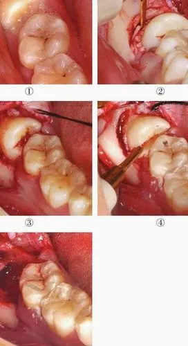 【图】超声骨刀在智齿拔除中的应用