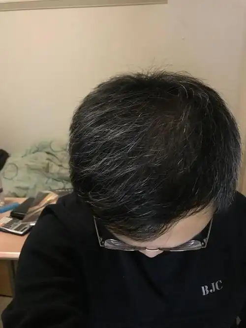 年纪轻轻长白发,找到原因很关键,中医支招:做好2步找回黑发