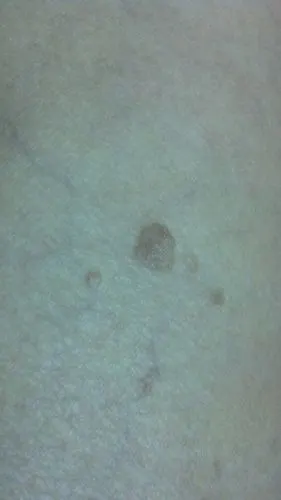 腿上长深色斑点,微微凸起不疼不痒,时间长了可以扣下一层皮,不知道是