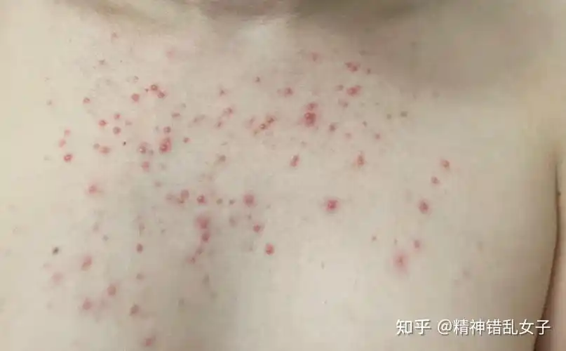 马拉色菌毛囊炎患者的痛苦