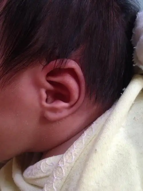 耳朵的两边对耳轮怎么不一样