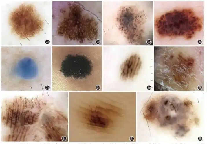 色痣皮肤镜诊断