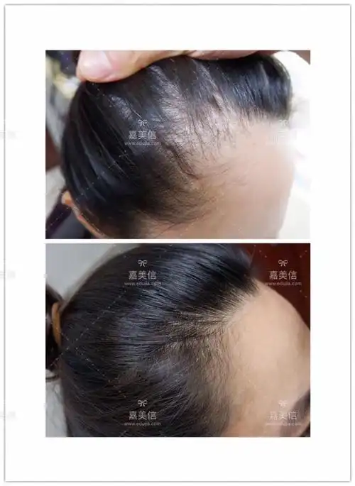 盘龙mini微移植生发发际线对比照片
